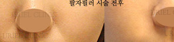 [귀족&무턱] 팔자주름필러(귀족필러) 시술 전 후