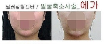 [라인업] EGA 주사