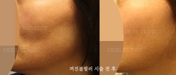 [볼&앞광대] 꺼진 볼필러 시술 전후
