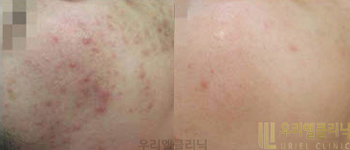 [리프팅&피부] 올인원 레이저 시술 전 후