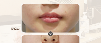 [입술] 필러성형센터 입술필러