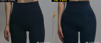 [바디클리닉] 골반필러