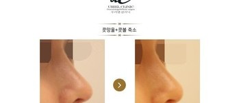 [보톡스] 콧망울 + 콧볼보톡스 시술 전 후