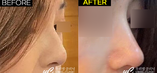 [코] 코필러 시술 전후